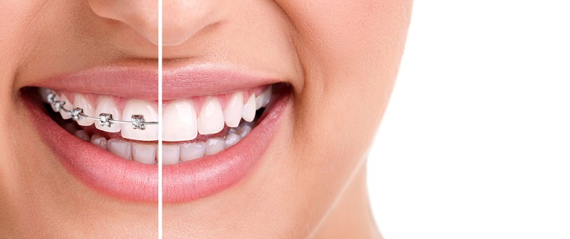 Brackets Metálicos